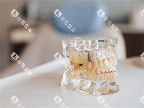 种植牙牙齿模型示意图