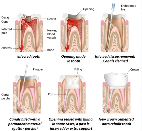 根管治疗过程图 根管治疗过程图