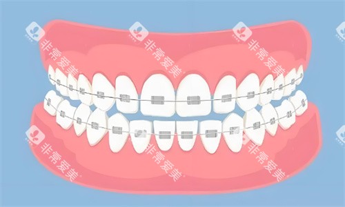 金属矫正牙齿