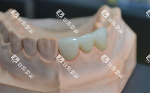 安装在牙齿模型上的全瓷牙成效 安装在牙齿模型上的全瓷牙成效