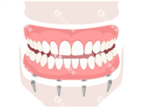 下牙床半口种植 下牙床半口种植
