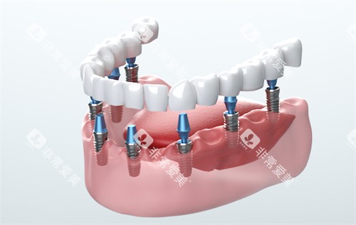 半口种植牙示意图 半口种植牙示意图