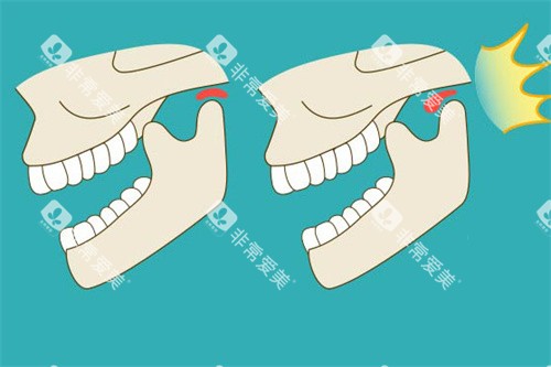 颞下颌关节紊乱疼痛