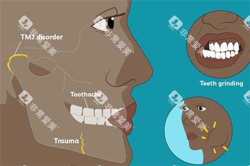 颞下颌关节紊乱