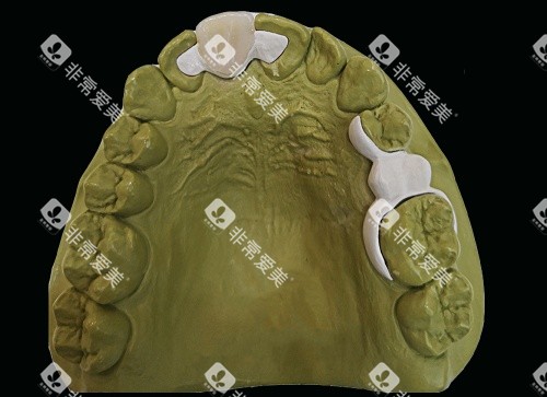 hpp粘接桥牙齿口腔内示意图