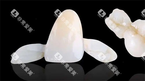 马里兰桥牙齿图片示意图