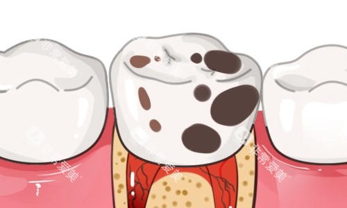 牙齿龋坏展示图 牙齿龋坏展示图