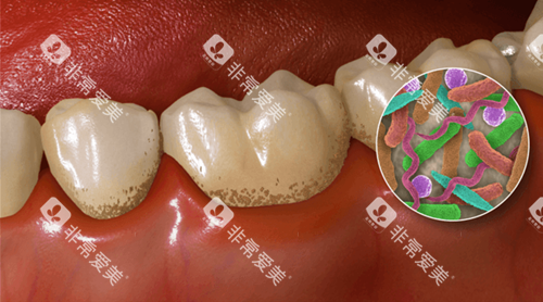 牙齿污垢卡通示意图 牙齿污垢卡通示意图