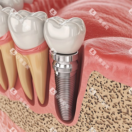 牙齿种植牙侧位解剖动画示意图 牙齿种植牙侧位解剖动画示意图