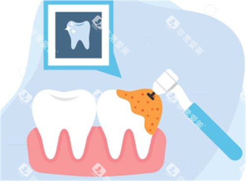 牙钻治疗牙齿图