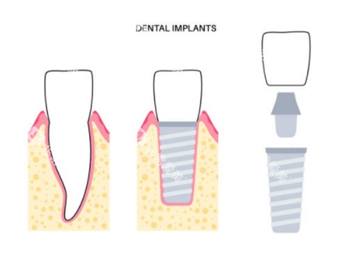 种植牙前后对比图片 种植牙前后对比图片