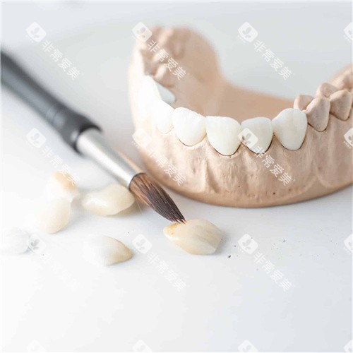 牙齿贴面成品图