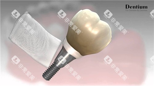 登腾种植牙和骨膜