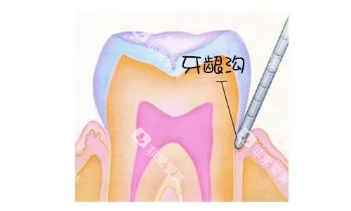 牙龈沟示意图.webp 牙龈沟示意图.webp