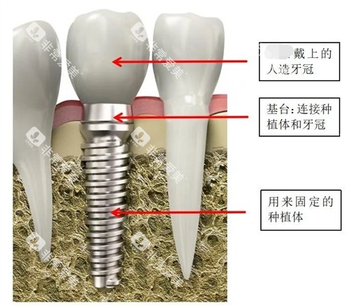 种植牙结构讲解漫画图