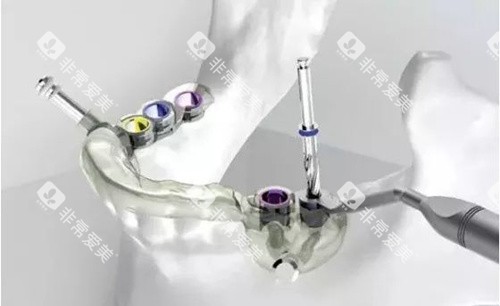 种植牙导板在手术中的应用 种植牙导板在手术中的应用