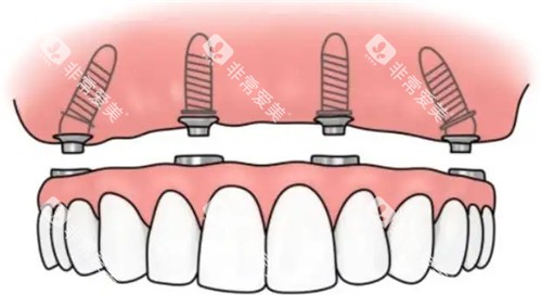 半固定种植牙卡通图