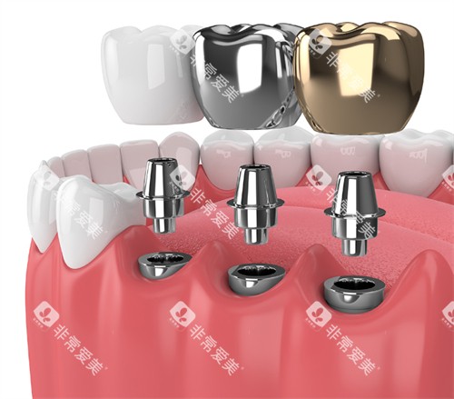 不同牙冠的种植牙