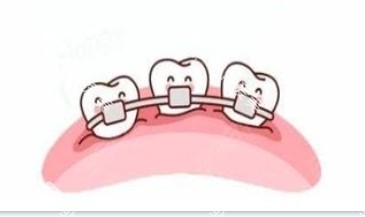 隐形牙齿矫正器和传统牙齿矫正器展示图
