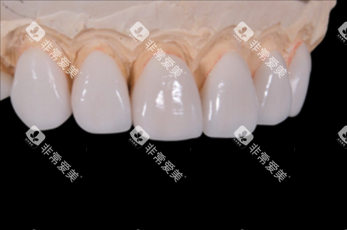 牙齿贴面修复展示 牙齿贴面修复展示