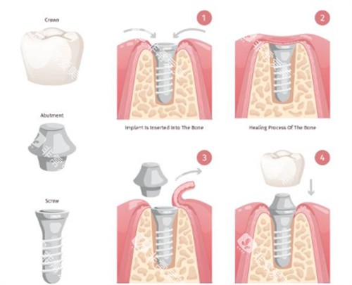 种植牙过程图