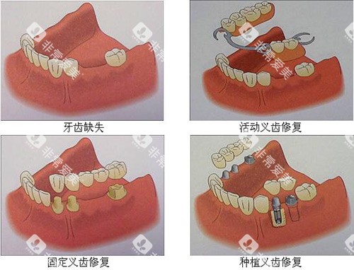 牙齿缺失修复多种方式
