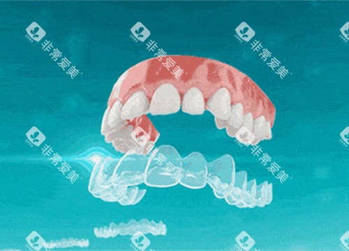 隐形矫正卡通示意图