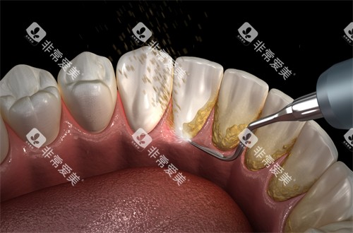 洗牙清洁牙齿结石