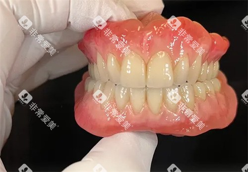 成品吸附性义齿