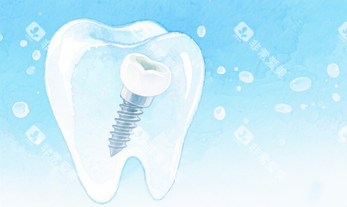 种植牙示意图 种植牙示意图
