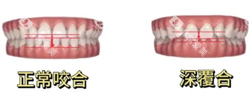 正常咬合和深覆合对比
