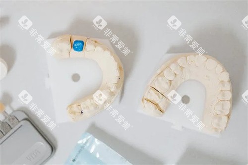 正畸咬合模型图