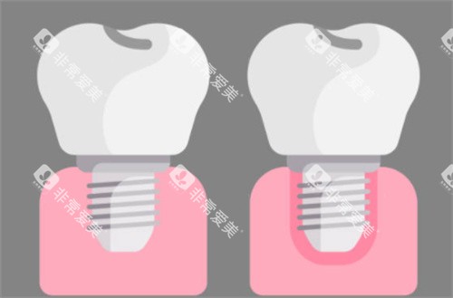 种植牙前后对比图 种植牙前后对比图