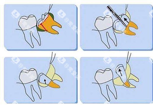不同智齿类型实验题