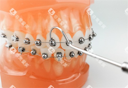 牙齿矫正OBrace球面托槽矫正牙套模型