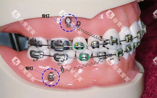牙齿矫正骨钉种植钉牙齿模型