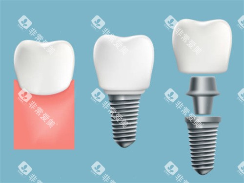 牙齿种植过程图 牙齿种植过程图