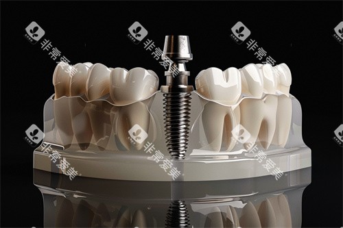 种植牙植体漫画示意图 种植牙植体漫画示意图
