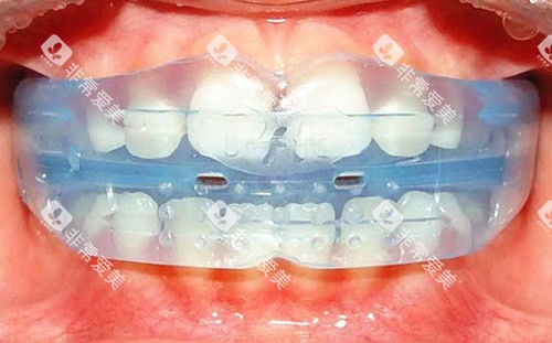 牙齿矫正MRC早期肌功能矫正