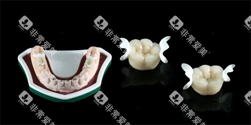 hpp粘接桥义齿模型展示图