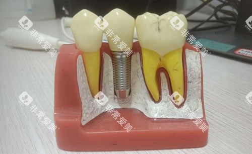 广州欧迈口腔种植牙模型图 广州欧迈口腔种植牙模型图