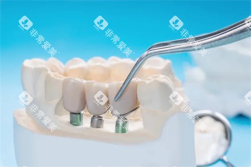 种植牙动画图展示 种植牙动画图展示