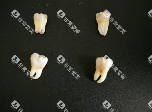 不同类型智齿实物展示图