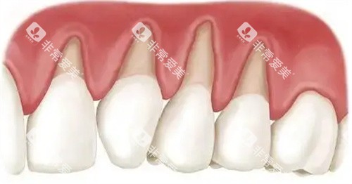 牙龈萎缩卡通图 牙龈萎缩卡通图