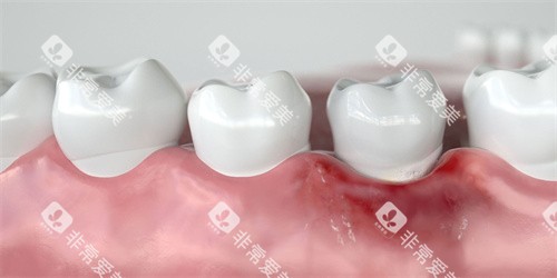 牙龈萎缩发红 牙龈萎缩发红