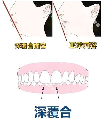 深覆合矫正前后脸型对比图片