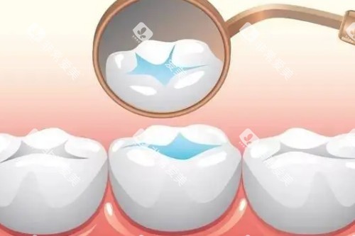 儿牙窝沟封闭卡通图 儿牙窝沟封闭卡通图