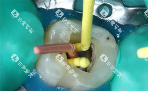 根管治疗手术过程图