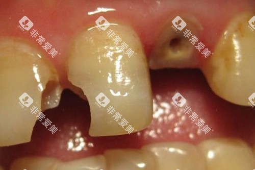 牙齿龋坏到牙根