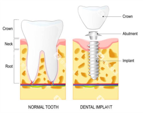 种植牙和正常牙齿对比图